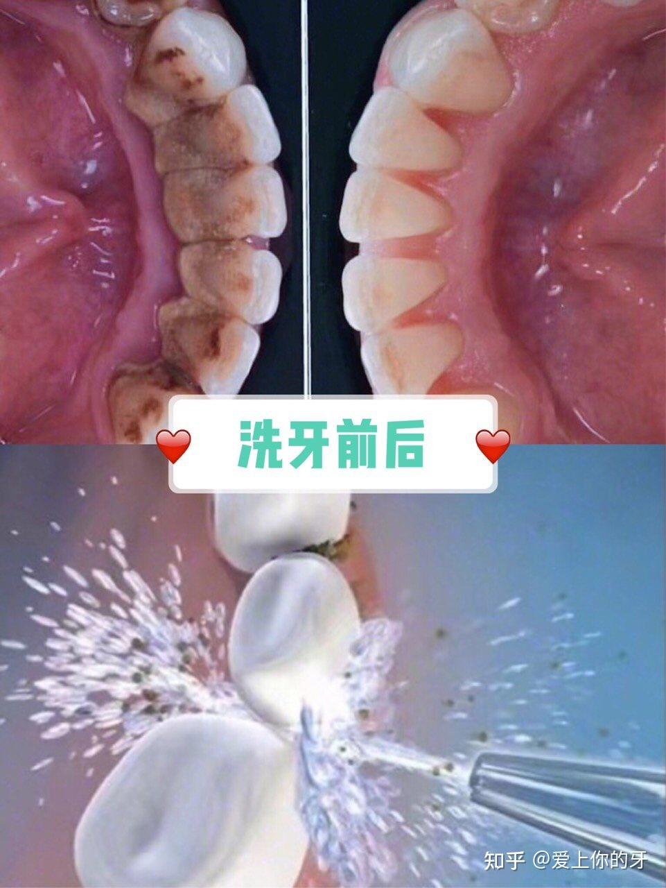 黑河洗牙可以用医保吗(洗牙可以用医保吗,报销比例多少)